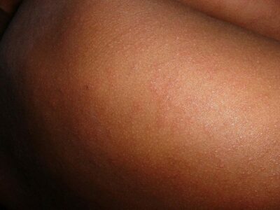 morbillo